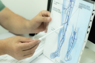Стадії розвитку варикозної хвороби нижніх кінцівок